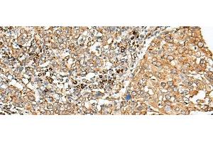Immunohistochemistry of paraffin-embedded Human cervical cancer tissue using STT3A Polyclonal Antibody at dilution of 1:70(x200) (STT3A Antikörper)