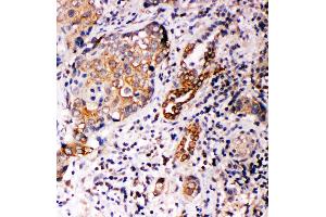 Anti-Annexin A10 antibody, IHC(P) IHC(P): Human Lung Cancer Tissue (Annexin a10 Antikörper  (C-Term))