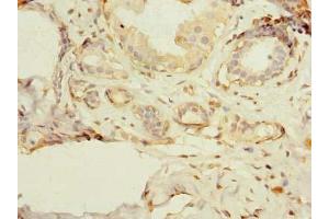 Immunohistochemistry of paraffin-embedded human breast cancer using ABIN7163030 at dilution of 1:100 (PSD4 Antikörper  (AA 1-300))