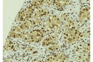 ABIN6267198 at 1/100 staining Human breast cancer tissue by IHC-P. (TLK1 Antikörper  (pSer743))