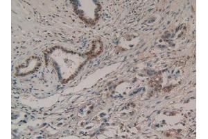 IHC-P analysis of Human Pancreas Cancer Tissue, with DAB staining. (EZH2 Antikörper  (AA 51-285))