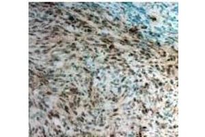 Twist1 Antibody staining Twist in Mouse pancreatic cancer tissue sections by Immunohistochemistry (TWIST1 Antikörper)