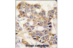 Formalin-fixed and paraffin-embedded human breast carcinoma tissue reacted with P9 antibody (C-term) (ABIN390154 and ABIN2840653) , which was peroxidase-conjugated to the secondary antibody, followed by DAB staining. (MMP 9 Antikörper  (C-Term))