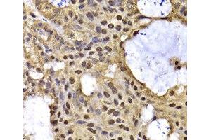 Immunohistochemistry of paraffin-embedded Human oophoroma using ARID3A Polyclonal Antibody at dilution of 1:100 (40x lens). (ARID3A Antikörper)