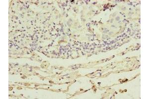 Immunohistochemistry of paraffin-embedded human lung cancer using ABIN7164324 at dilution of 1:100 (RARS2 Antikörper  (AA 17-340))