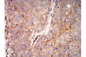 Immunohistochemical analysis of paraffin-embedded bladder cancer tissues using RALB mouse mAb with DAB staining.