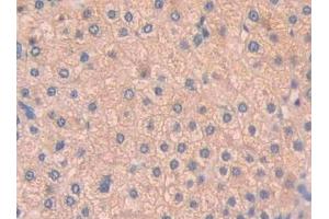 Detection of PAH in Human Liver cancer Tissue using Polyclonal Antibody to Phenylalanine Hydroxylase (PAH) (Phenylalanine Hydroxylase Antikörper  (AA 228-452))
