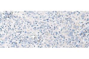 Immunohistochemistry of paraffin-embedded Human cervical cancer tissue using STAU2 Polyclonal Antibody at dilution of 1:45(x200) (Double-stranded RNA-binding protein Staufen homolog 2 (STAU2) Antikörper)