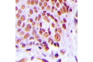 Immunohistochemical analysis of C/EBP gamma staining in human breast cancer formalin fixed paraffin embedded tissue section. (CEBPG Antikörper)