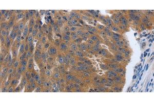 Immunohistochemistry of paraffin-embedded Human ovarian cancer tissue using PDGFA Polyclonal Antibody at dilution 1:70 (PDGFA Antikörper)