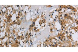 Immunohistochemistry of paraffin-embedded Human thyroid cancer using SYN1 Polyclonal Antibody at dilution of 1:40 (SYN1 Antikörper)