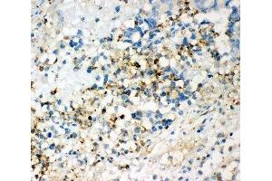 IHC-P: CD63 antibody testing of human intestinal cancer tissue (CD63 Antikörper  (AA 97-238))