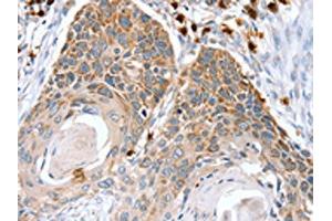 The image on the left is immunohistochemistry of paraffin-embedded Human esophagus cancer tissue using ABIN7130898(RNF185 Antibody) at dilution 1/20, on the right is treated with fusion protein.