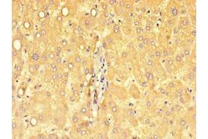 Immunohistochemistry of paraffin-embedded human liver cancer using ABIN7149746 at dilution of 1:100 (DSE Antikörper  (AA 23-270))