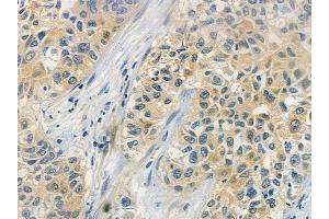 ABIN6257889 and ABIN6273760 at 1/100 staining human lung squamous cell carcinoma by IHC-P.