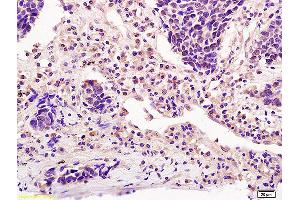 Formalin-fixed and paraffin embedded human lung carcinoma labeled with Anti-ICOS/CD278 Polyclonal Antibody, Unconjugated (ABIN742380) at 1:200 followed by conjugation to the secondary antibody and DAB staining (ICOS Antikörper  (AA 51-150))