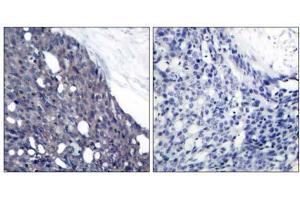 Immunohistochemical analysis of paraffin-embedded human breast carcinoma tissue using IκB-α (Ab-42) antibody (E021176). (NFKBIA Antikörper)