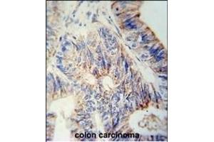 B3GNT6 Antibody (Center) (ABIN653842 and ABIN2843106) immunohistochemistry analysis in formalin fixed and paraffin embedded human colon carcinoma followed by peroxidase conjugation of the secondary antibody and DAB staining. (B3GNT6 Antikörper  (AA 146-173))
