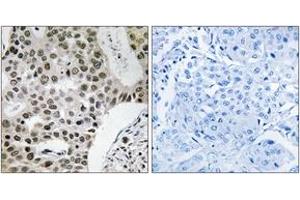 Immunohistochemistry analysis of paraffin-embedded human breast carcinoma tissue, using ZMYM4 Antibody.