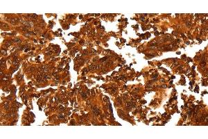 Immunohistochemistry of paraffin-embedded Human gastic cancer using ALDOA Polyclonal Antibody at dilution of 1:30 (ALDOA Antikörper)