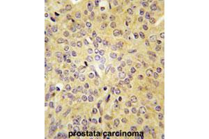 Formalin-fixed and paraffin-embedded human prostate carcinomareacted with LARS polyclonal antibody , which was peroxidase-conjugated to the secondary antibody, followed by AEC staining. (LARS Antikörper  (C-Term))
