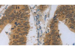 Immunohistochemistry of paraffin-embedded Human colon cancer using TNFRSF11B Polyclonal Antibody at dilution of 1:30 (Osteoprotegerin Antikörper)