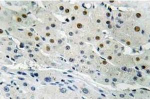 Immunohistochemistry (IHC) analyzes of Dlx-4 antibody in paraffin-embedded human liver carcinoma tissue. (DLX4 Antikörper)