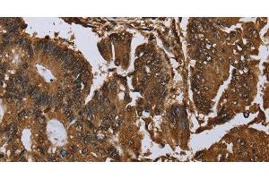 Immunohistochemistry of paraffin-embedded Human colon cancer tissue using MYBBP1A Polyclonal Antibody at dilution 1:40