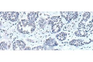 Immunohistochemistry of paraffin-embedded Human esophagus cancer tissue using RARG Polyclonal Antibody at dilution of 1:55(x200) (Retinoic Acid Receptor gamma Antikörper)
