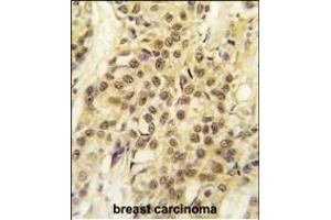 Formalin-fixed and paraffin-embedded human breast carcinoma tissue reacted with HMOF/MYST1 antibody (C-term) (ABIN387971 and ABIN2844732) , which was peroxidase-conjugated to the secondary antibody, followed by DAB staining.