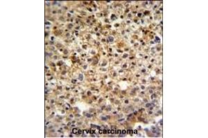 KI Antibody (C-term) (ABIN651358 and ABIN2840200) IHC analysis in formalin fixed and paraffin embedded human cervix carcinoma followed by peroxidase conjugation of the secondary antibody and DAB staining. (CCDC180 Antikörper  (C-Term))