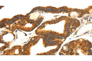 Immunohistochemistry of paraffin-embedded Human thyroid cancer tissue using SMYD4 Polyclonal Antibody at dilution 1:40 (SMYD4 Antikörper)