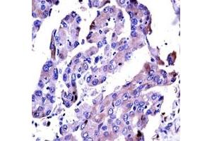 AKT2 antibody immunohistochemistry analysis in formalin fixed and paraffin embedded human lung adenocarcinoma.