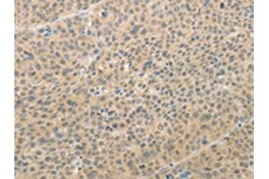 The image on the left is immunohistochemistry of paraffin-embedded Human liver cancer tissue using ABIN7189710(AFF2 Antibody) at dilution 1/25, on the right is treated with synthetic peptide. (AFF2 Antikörper)
