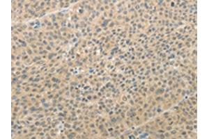 The image on the left is immunohistochemistry of paraffin-embedded Human liver cancer tissue using ABIN7189710(AFF2 Antibody) at dilution 1/25, on the right is treated with synthetic peptide.