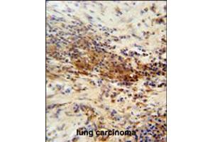 DNAJC11 antibody immunohistochemistry analysis in formalin fixed and paraffin embedded human lung carcinoma followed by peroxidase conjugation of the secondary antibody and DAB staining. (DNAJC11 Antikörper  (N-Term))