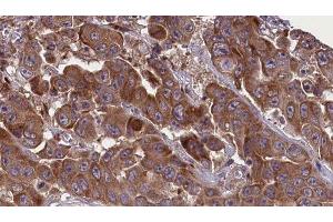 ABIN6277630 at 1/100 staining Human liver cancer tissue by IHC-P. (GNAS Antikörper  (C-Term))