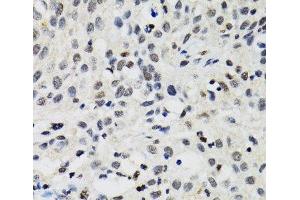 Immunohistochemistry of paraffin-embedded Human lung cancer using SMARCAD1 Polyclonal Antibody at dilution of 1:100 (40x lens). (SMARCAD1 Antikörper)