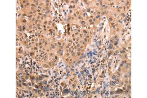 Immunohistochemistry of Human lung cancer using ACO2 Polyclonal Antibody at dilution of 1:30 (ACO2 Antikörper)