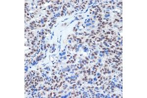 Immunohistochemistry of paraffin-embedded human thyroid cancer using RING1A Rabbit mAb (ABIN7270051) at dilution of 1:100 (40x lens). (RING1 Antikörper)