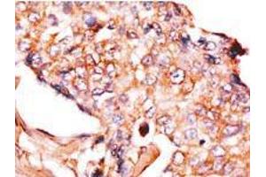 Formalin-fixed and paraffin-embedded human breast carcinoma reacted with anti-NP1 (Nptx1) Antibody (Center), which was peroxidase-conjugated to the secondary antibody, followed by DAB staining. (NPX1 Antikörper  (Middle Region))