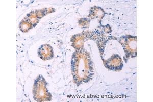 Immunohistochemistry of Human thyroid cancer using ADCY5 Polyclonal Antibody at dilution of 1:30 (ADCY5 Antikörper)