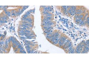 Immunohistochemistry of paraffin-embedded Human colon cancer using NCAPD2 Polyclonal Antibody at dilution of 1:40 (NCAPD2 Antikörper)