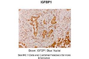 Sample Type :  Human lung adenocarcinoma  Primary Antibody Dilution :  1:300  Secondary Antibody :  Anti-rabbit-linker, Fbex-HRP  Secondary Antibody Dilution :  NOT FOUND  Color/Signal Descriptions :  Brown: IGFBP1 Blue: Nuclei  Gene Name :  IGF2BP1  Submitted by :  Haodong Xu. (IGF2BP1 Antikörper  (N-Term))