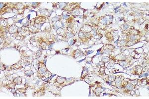 Immunohistochemistry of paraffin-embedded Human mammary cancer using SLC7A2 Polyclonal Antibody at dilution of 1:100 (40x lens). (SLC7A2 Antikörper)