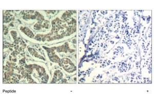 Immunohistochemical analysis of paraffin-embedded human breast carcinoma tissue using ATR polyclonal antibody . (ATR Antikörper  (Ser428))