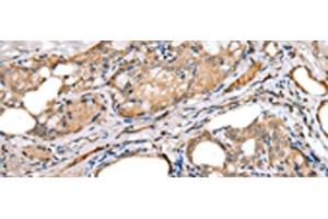 Immunohistochemistry of paraffin-embedded Human thyroid cancer tissue using LRRC19 Polyclonal Antibody at dilution of 1:30(x200)