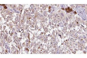 ABIN6275310 at 1/100 staining Human Melanoma tissue by IHC-P. (VGF Antikörper  (Internal Region))