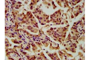 IHC image of ABIN7169791 diluted at 1:600 and staining in paraffin-embedded human lung cancer performed on a Leica BondTM system. (SLC2A4RG Antikörper  (AA 1-100))