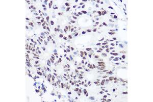 Immunohistochemistry of paraffin-embedded human colon carcinoma using S Rabbit pAb (ABIN6128698, ABIN6147392, ABIN6147393 and ABIN6215703) at dilution of 1:100 (40x lens). (SART3 Antikörper  (AA 664-963))
